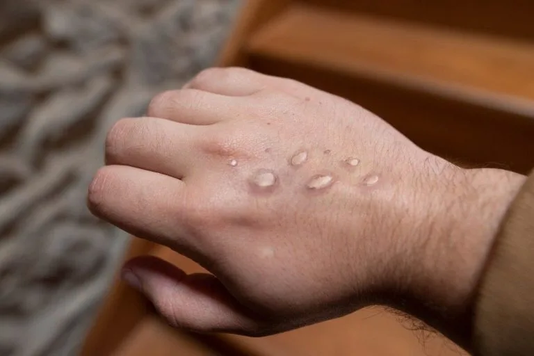 monkeypox in Uganda